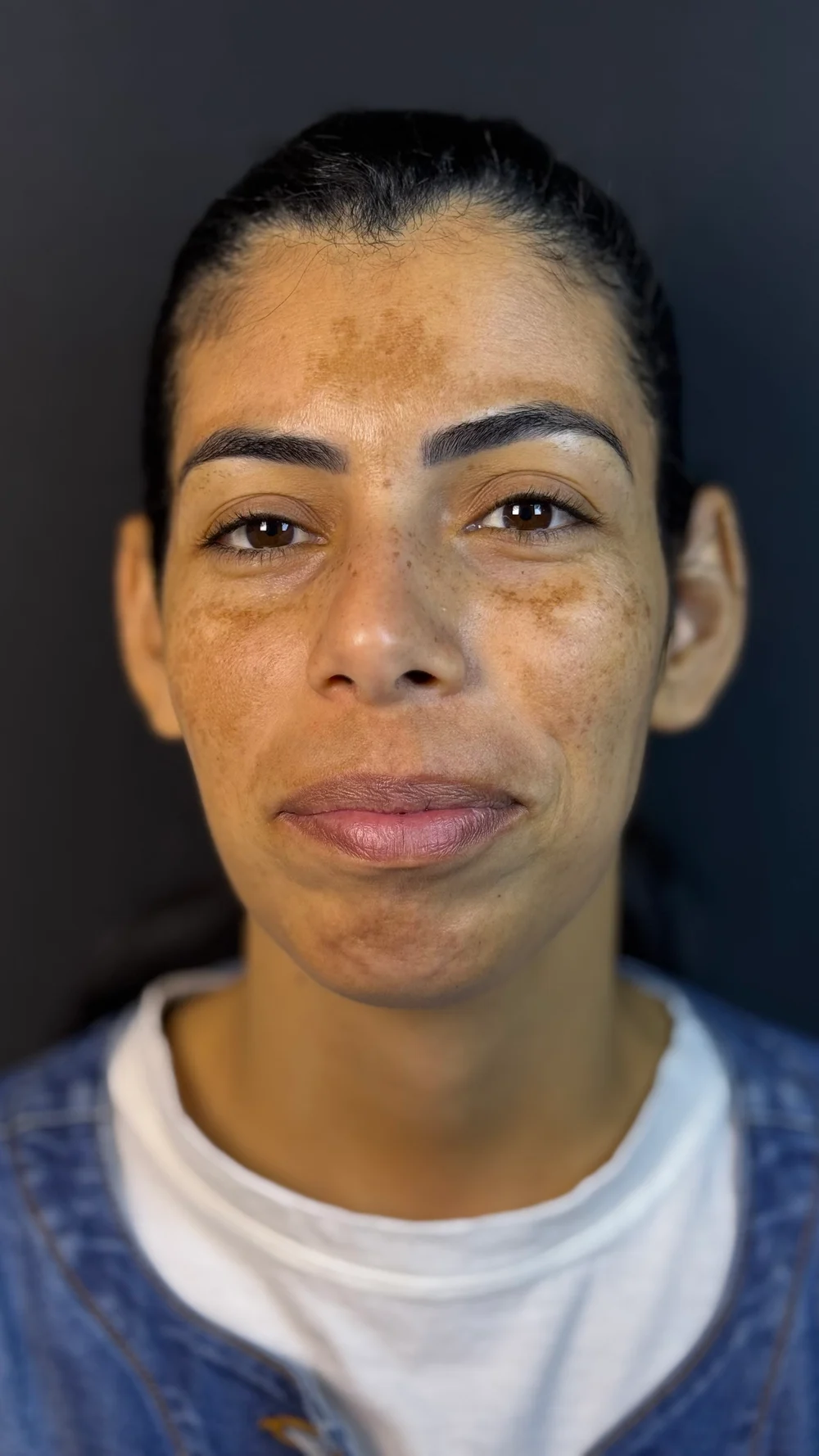 Antes de tratamento de melasma